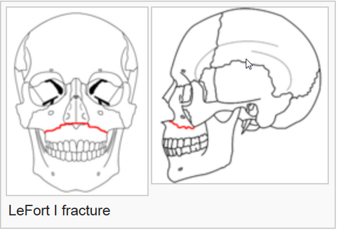 <p>produced by a direct blow to the anterior of the alveolar process of the maxilla and separates the alveolar process from the maxillary body</p>