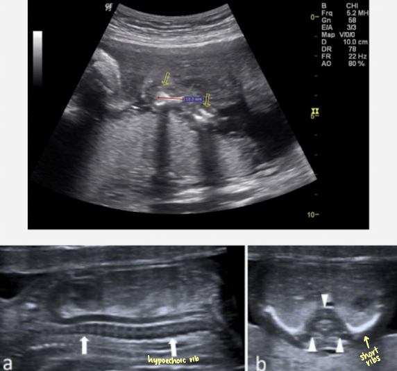 <ul><li><p>severe micromelia</p></li><li><p>small thorax and ribs</p></li><li><p>protuberant abdomen</p></li><li><p><span style="color: red;">hypomineralization (spine)</span></p></li><li><p>macrocephaly</p></li><li><p>micrognathia</p></li><li><p>polyhydramnios</p></li><li><p>hydrops (possibly)</p></li></ul><p></p>