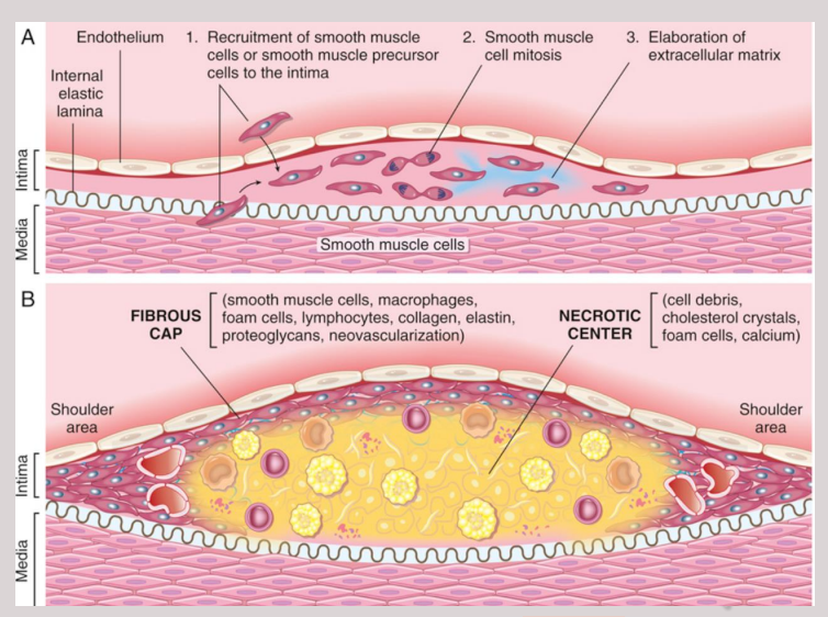 <p><span style="background-color: transparent; font-family: "Times New Roman", serif;">Atherosclerosis is characterized by an intimal plaque containing a fibrous cap and a necrotic lipid core with foam cells and cholesterol clefts</span></p>