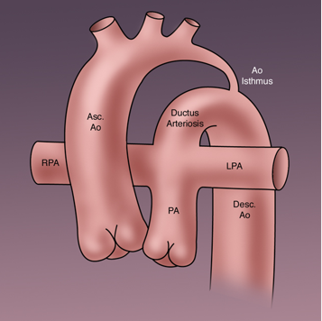 <ul><li><p>bicuspid ao valve (46%) </p></li><li><p>PDA</p></li><li><p>abn of subclavian art</p><ul><li><p>origin relative to duct or ligament determines the lenght of the ao isthmus </p></li></ul></li></ul><p></p>