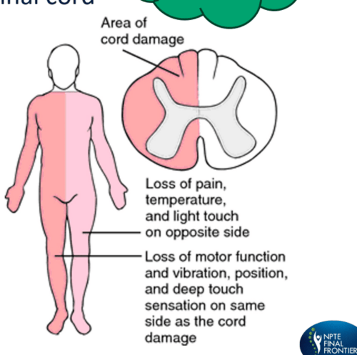 <p>stab gunshot wound</p><p>-ipsilateral motor loss (corticospinal)</p><p>-ipsilateral proprioception, light touch, vibration loss (dorsal column)</p><p>-contralateral loss of pain and temperature sensation (spinothalamic)</p><p>nemonic: brown pott</p>