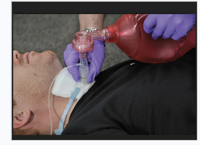 <p>Special Considerations in Airway Management and Ventilation </p>