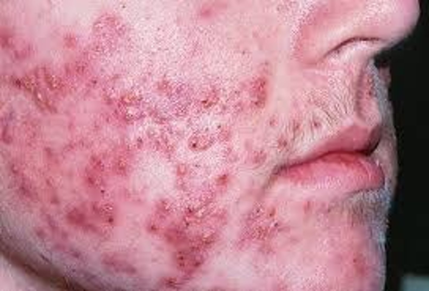 <p>all of inflammatory acne OR</p><p>Isotretinoin (accutane)</p>