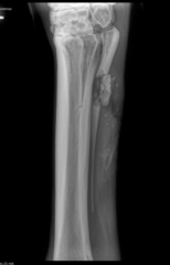 <p>What is the common etiology of metatarsal 2 & 4 fractures (splint bones)?</p>