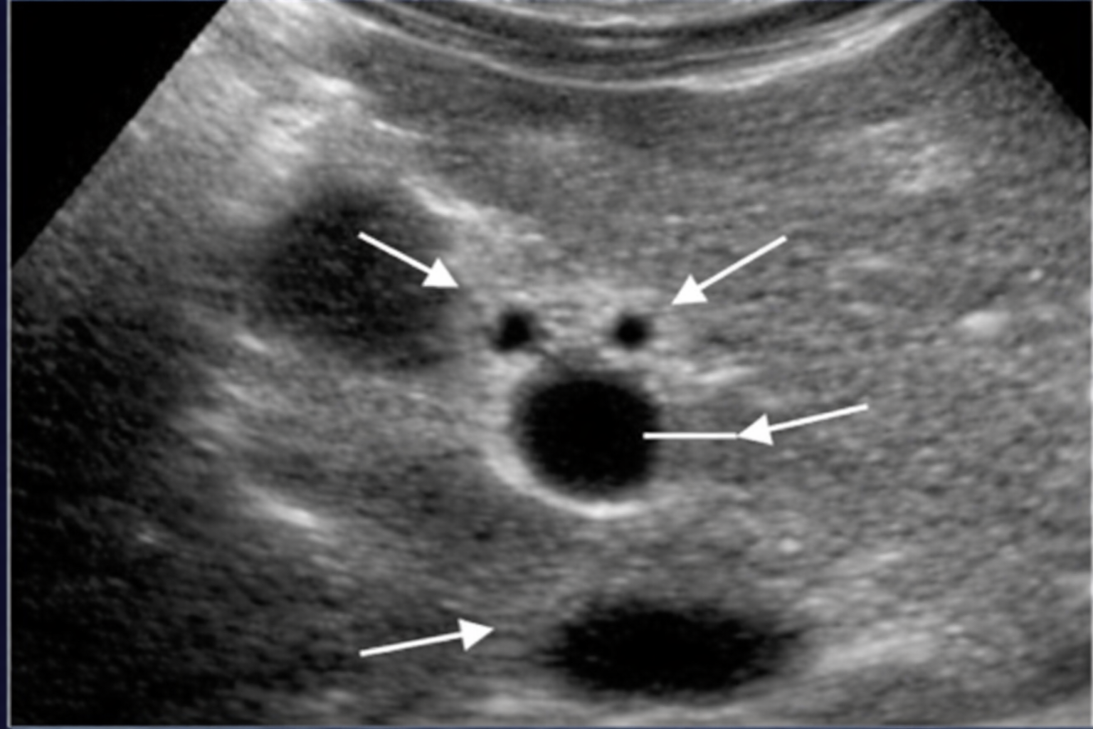<p>Label Anatomy of PortaHepatis TRV</p>