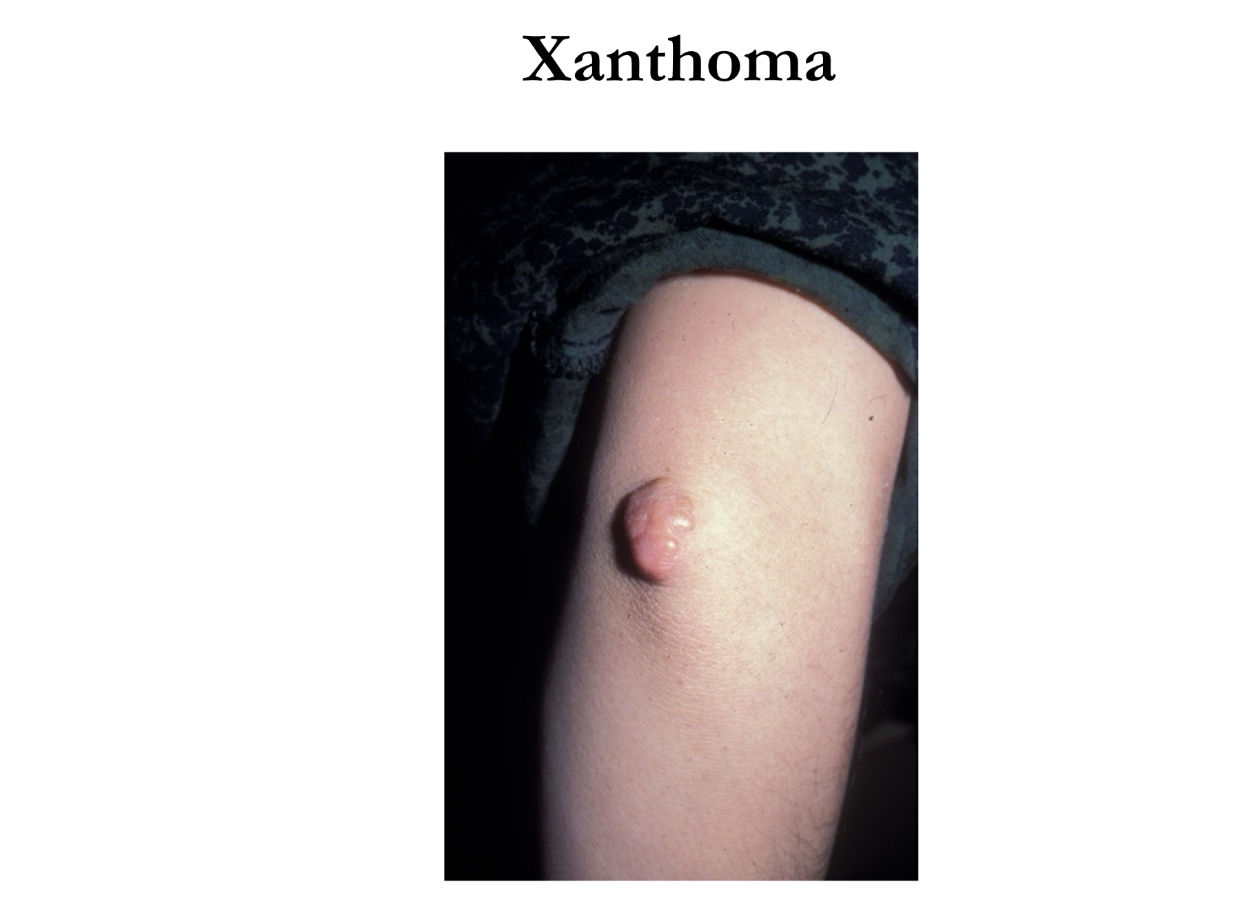 <p>Genetic disorder causing high LDL and cholesterol lvls in blood, LDL receptor broken or absent meaning LDLs cannot be removed from blood </p><p>Causes very high risk of atherosclerosis and xanthomas </p>