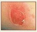 <p>What is the type of lesion and how is it defined?</p>