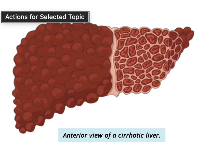 <ul><li><p>a slow, progressive disease </p></li><li><p>healthy liver tissue is replaced by scar tissue</p></li><li><p>prevents liver from functioning normally </p></li></ul><p></p>