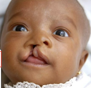 <p>defective fusion of the medial nasal process with the maxillary process </p>