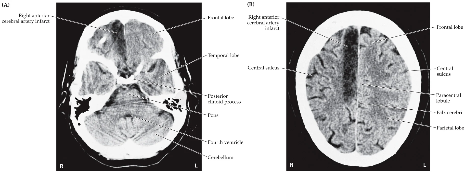 <p>Infarct of right medial frontal lobe including foot motor cortex, right anterior cerebral artery</p>