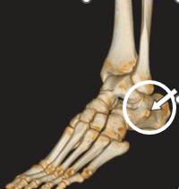 <p>What is the bony landmark of the foot circled in the following picture:</p>