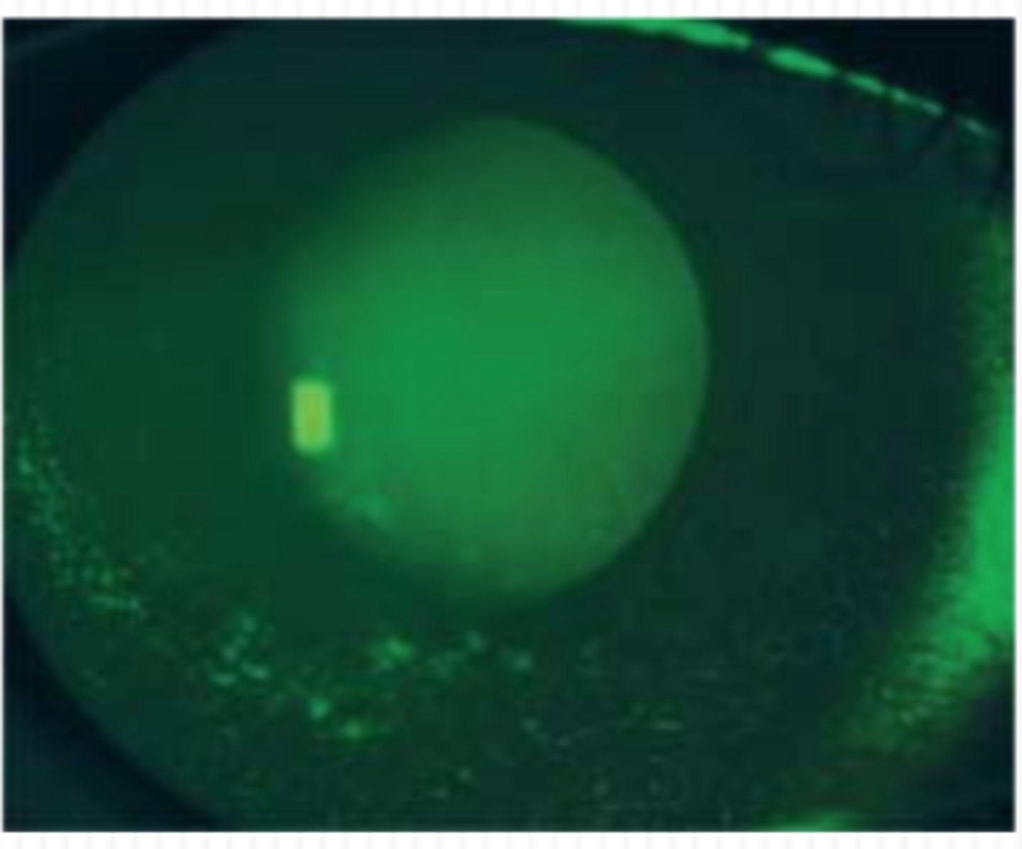 <p>Isolated or diffuse dots across a larger area of the cornea. An isolated pattern may be due to a poor contact lens fit or infection, while a diffuse pattern may indicate solution toxicity or an interaction between certain lens/solution combinations or dry eye syndrome.</p>
