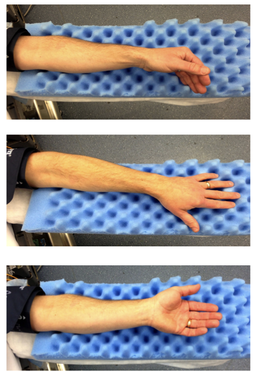 <p>What image is A/W highest risk of ulnar neuropathy?</p>