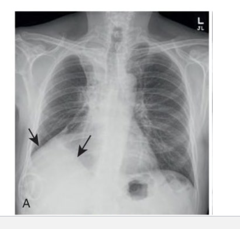 <p>since there is fluid outside the lungs, see increased opacities on the affected side.</p>