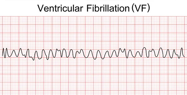 <p>you are dead, ventricles are quivering, clients have no pulse/BP/RR. fatal if not terminated in 3-5 minutes. Want Coarse v fib rather than fine because there is more of a rhythm to shock.</p>