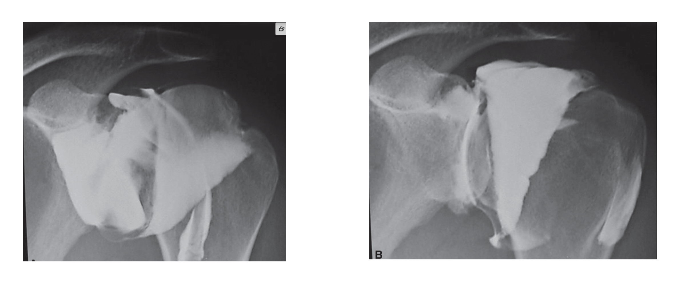 <p>which image demonstrates adhesive capsulitis? </p>