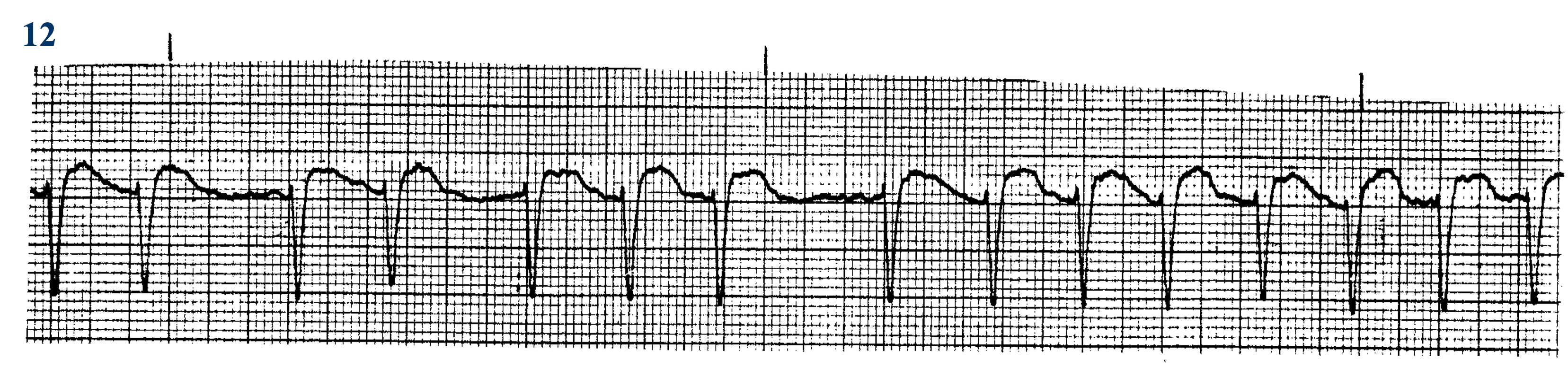<p>What ECG is this? </p>