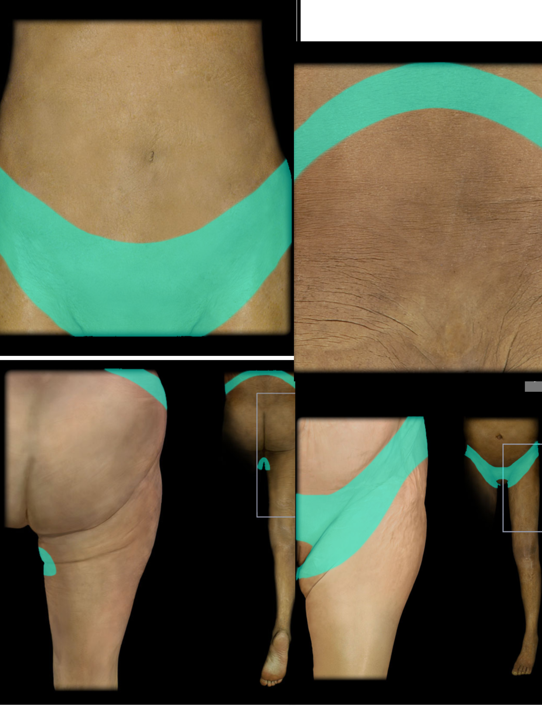 <p>L1 Dermatome</p>