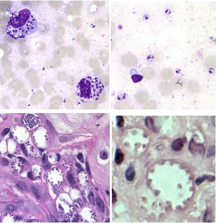 <p>Leishmania spp., amastigotes</p><p>Disease: <u>Leishmaniasis</u></p><p>Vector: <u>Sandfly</u></p><p>Infective stage: <u>Promastigote </u></p><p>Diagnostic stage: <u>Amastigote</u></p><p>Treatment: Amphotericin B</p>