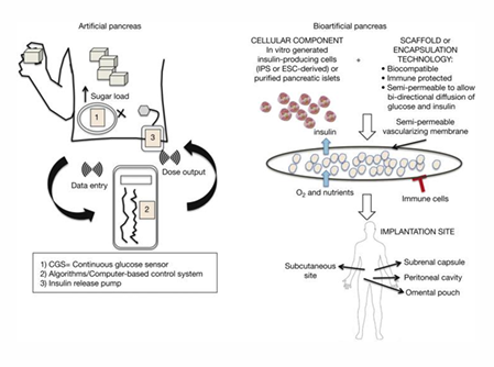 <p>The artificial pancreas uses electronics to measure glucose and deliver insulin, while the bioartificial pancreas uses living insulin-producing cells protected inside an implanted biomaterial device.</p>