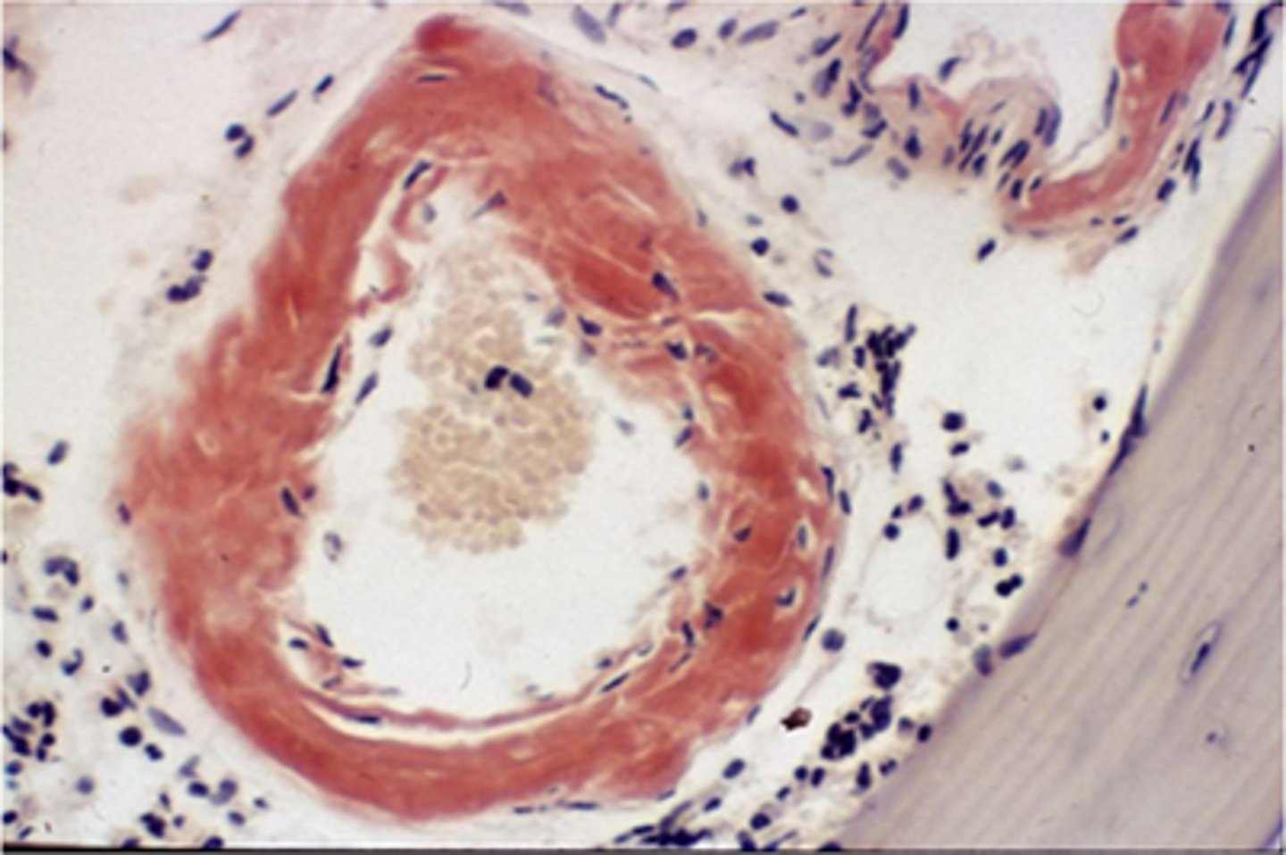 <p>amyloid</p><p>Feedback:</p><p>Amyloid has been stained orange-red by the Congo red technique. Collagen unstained in the lower right corner of the image.</p>