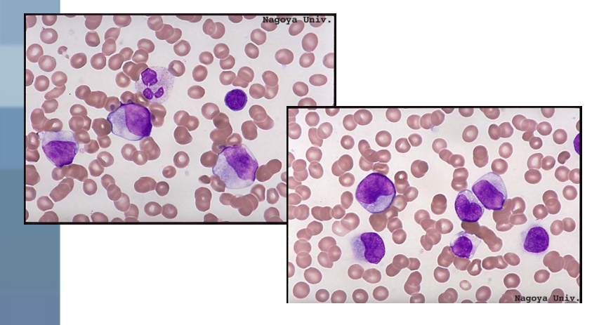 <p>what are the lab findings for AML?</p>