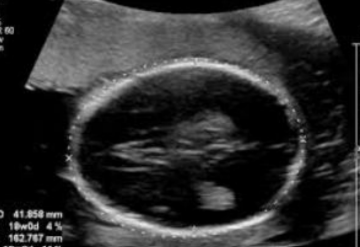 <p>What is this ultrasound image depicting?</p><p>a. Normal anatomy</p><p>b. Enlarged third ventricle</p><p>c. Enlarged lateral ventricle</p><p>d. Agenesis of the corpus callosum</p>