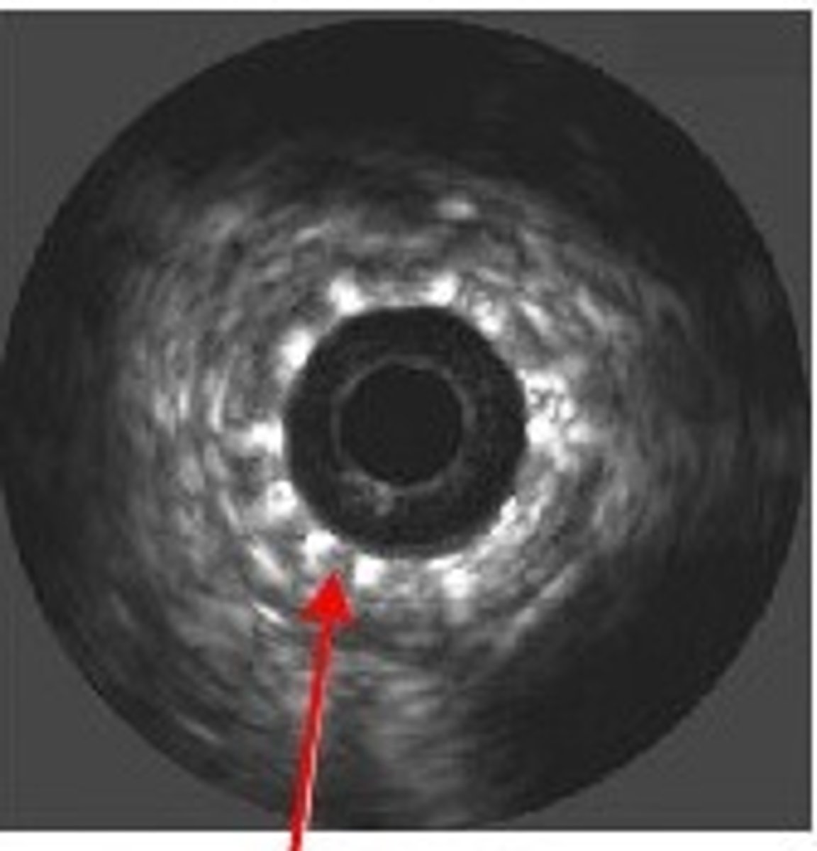 <p>This stent is fully apposed</p>