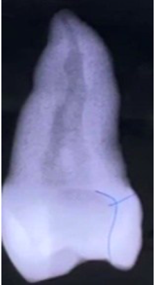 <p><span style="color: red;"><span>iatrogenic mistake</span></span><span> during access cavity preparation on the lateral walls or pulp chamber floor, it </span><span style="color: red;"><span>should be straight</span></span></p><p><strong><span>treatment:</span></strong><span> </span><span style="color: red;"><span>fill it</span></span></p>