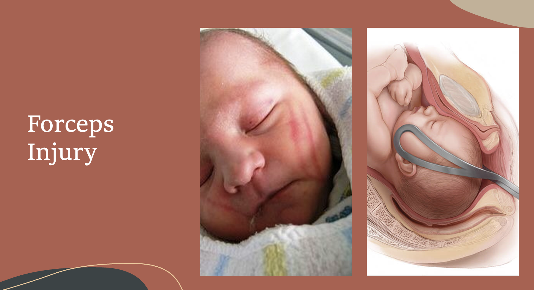 <p>Forceps Injury</p>