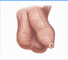<p>narrowing of the opening of the prepuce over the glans penis</p><p>-a normal variant if congenital</p>