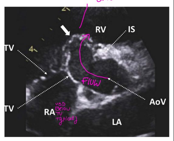 <p>The VSD may be restricted by tricuspid septal leaflet tissue, which can cause <strong>tricuspid septal leaflet distortion</strong> and <strong>tricuspid regurgitation</strong>.</p><p></p><p>That means the <strong>septal leaflet of the tricuspid valve partly covers the VSD</strong>, making the opening smaller.</p><p>So instead of blood flowing freely through a large hole, the tricuspid valve tissue acts like a flap over it and <strong>restricts the amount of shunting</strong>.</p><p>Simple way to remember:</p><figure data-type="blockquoteFigure"><div><blockquote><p><strong>Restricted by tricuspid septal leaflet tissue = tricuspid valve tissue partially blocks the VSD.</strong></p></blockquote><figcaption></figcaption></div></figure><p>This is also why some perimembranous VSDs can appear smaller over time, even though the membranous tissue itself does not grow closed.</p>