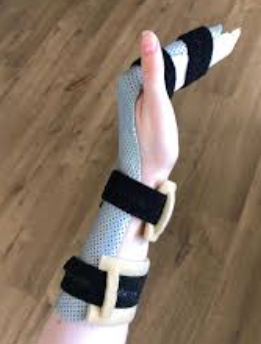 <p>Limits tension on flexor tendons of digits to minimize risk of rupture after flexor tendon repair</p>