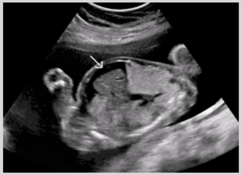 <ul><li><p><span style="background-color: transparent;">Most common neoplasm in newborn</span></p></li><li><p><span style="background-color: transparent;">Formed from remnants of primitive streak</span></p></li><li><p><span style="background-color: transparent;">Benign tumor that has elements of incomplete differentiated germ layers</span></p></li><li><p><span style="background-color: transparent;">Mostly found in females</span></p></li></ul><p></p>