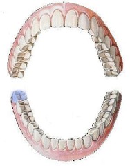 <p>mandibular right third molar</p>