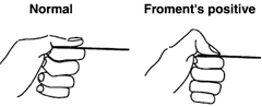 <p>Grasp paper between thumb/index; flexion of thumb terminal phalanx indicates adductor pollicis paralysis.</p>