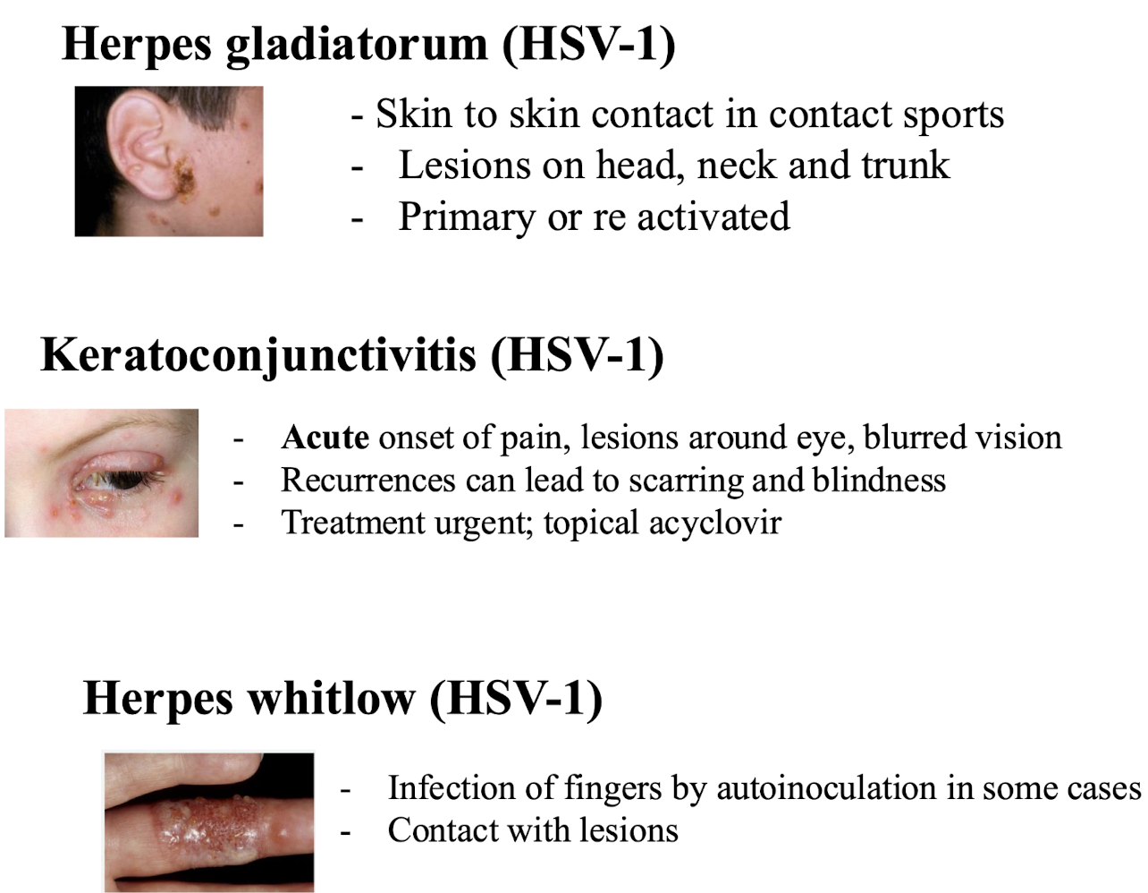 <p><strong><mark data-color="red" style="background-color: red; color: inherit;">Herpes gladiatorum (HSV-1)</mark></strong></p><p>- Skin to skin contact in contact sports, present as head, neck or trunk lesions, can be linked with primary or re-activated infection</p><p><strong><mark data-color="red" style="background-color: red; color: inherit;">Keratoconjunctivitis (HSV-1)</mark></strong></p><p>→ Acute onset of pain, lesions around eye, blurred vision, recurrences can lead to scarring and blindness; <span style="color: red;">treatment urgent;</span> topical acyclovir</p><p><strong><mark data-color="red" style="background-color: red; color: inherit;">Herpes whitlow</mark></strong></p><p>→ Infection of fingers by autoinoculation in some cases, or via lesion contact</p>