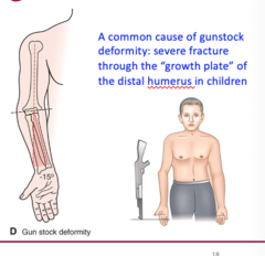 <p>-15 degrees</p><p>A common cause of gunstock deformity: severe fracture through the "growth plate" of the distal humerus in children</p>