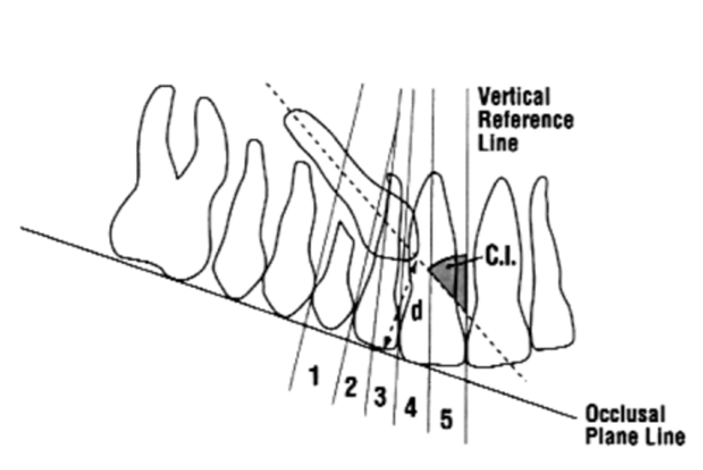 <p>Canine inclination (C.I.) to the midline, perpendicular distance (d) from the occlusal plane line, and zones (1-5) of the impacted canine crown. If <strong>canine angulation is more than 30 degree to the midline</strong>, the chances of spontaneous eruption after deciduous extraction are ___________</p>