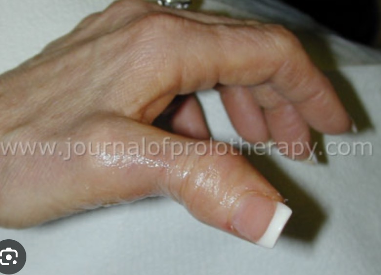<p>Associated with rheumatoid arthritis </p>
