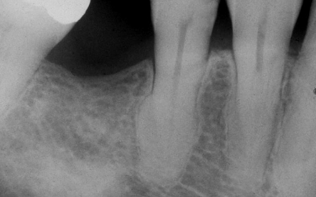 <p>mostly affect mandibular molars followed by 2nd premolars, can be caused by local factors or systemic factors</p>