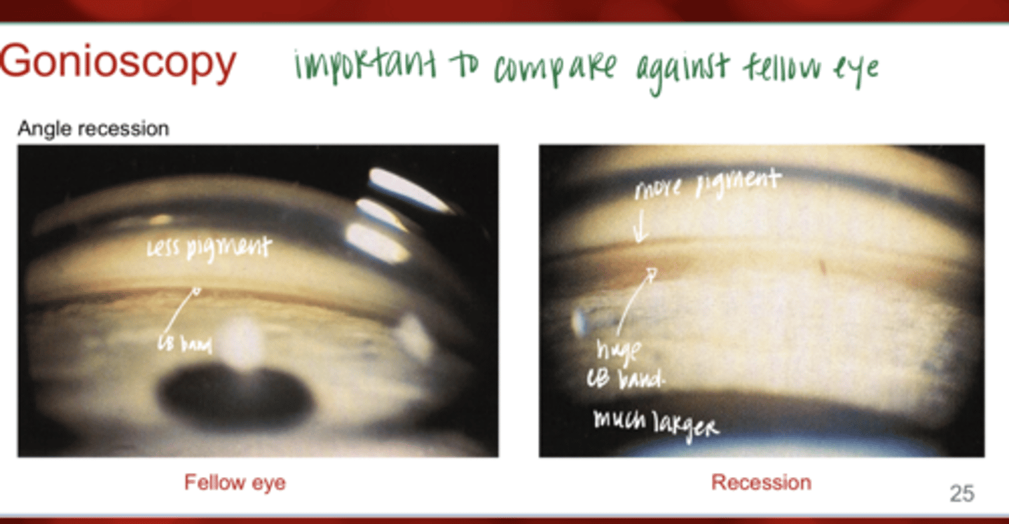 <p>Angle Recession -- Important to Compare to Fellow Eye (Pic)</p>