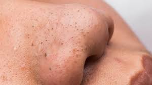 <p>Primary lesions; dark bumps clogged with sebum (oil); fine to massage with caution.</p>