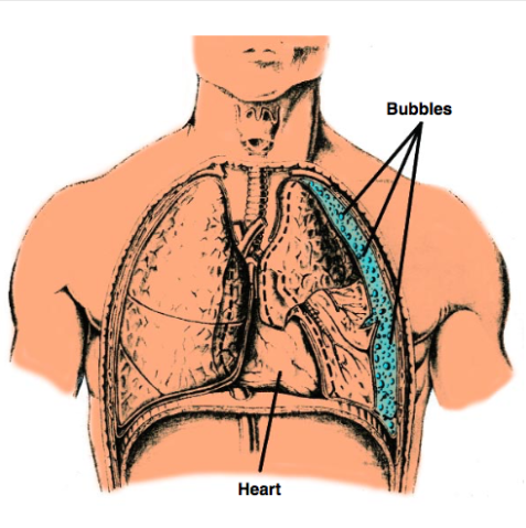 <p>A pneumothorax (collapsed lung) during ascent in diving is a severe form of pulmonary barotrauma caused by the expansion of trapped air within the pleural space as ambient pressure decreases<span>. It is a life-threatening emergency because the <strong>air bubble expands</strong>, often doubling in size when ascending from just 10 meters, which can turn </span><mark data-color="rgba(0, 0, 0, 0)" style="background-color: rgba(0, 0, 0, 0); color: inherit;">a minor, asymptomatic lung tear into a fatal condition</mark></p>