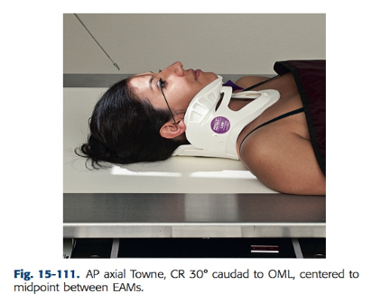 <ul><li><p>Angle CR 30 degrees caudal to OML or 37 degrees caudal to IOML. Once again, note that a patient in a c-collar with the neck extended will have OMLs and IOMLs that vary from the conventional parallel and perpendicular relationships formed through routine positioning </p></li><li><p>Center CR to pass midway between EAMs and exiting the foramen magnum. This centers CR to MSP 2 ½ “ (6 cm) above superciliary arch; then center IR to projected CR</p></li></ul><p></p>