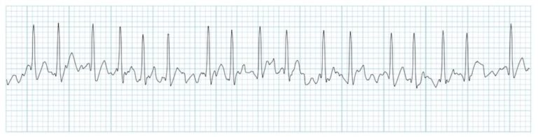<p>Rate: variable, ventricular response can be fast or slow </p><p>Regularity: irregularly irregular </p><p>No P waves </p>