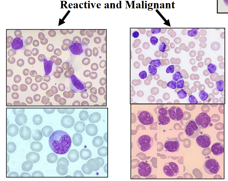 <p>Lymphocytosis (Reactive vs Malignant)</p>