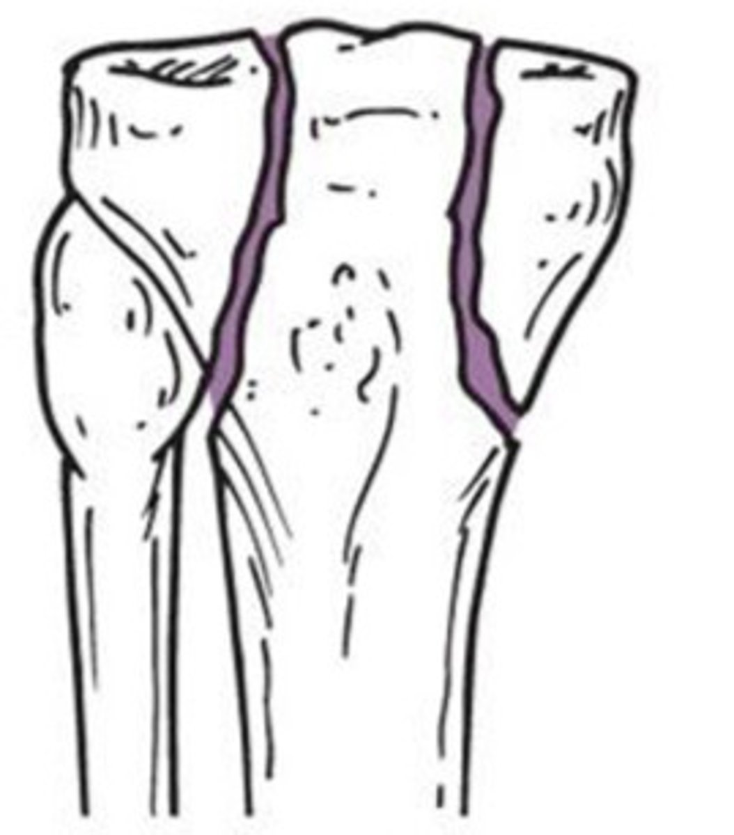 <p>What type of fracture does this show?</p>
