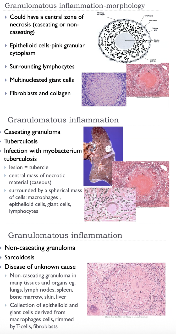 <ul><li><p>Aggregates of activated macrophages</p><ul><li><p>Epithelioid cells - epithelial-like appearance (large, pink, flat).</p></li><li><p>Giant cells - fusion of macrophages in response to chemical mediators (contain many nuclei).</p></li></ul></li><li><p>T-lymphocytes (causing chronic macrophage activation).</p></li><li><p>Rim of fibroblasts and connective tissue.</p></li><li><p>Central zone of necrosis.</p></li><li><p>'Walls off' offending agent-defense mechanism.</p></li><li><p>Subsequent fibrosis may cause dysfunction.</p></li></ul><p></p><p>Granulomatous inflammation is characterised by the formation of <strong>granulomas</strong>, which are organised collections of <strong>epithelioid macrophages</strong>—activated macrophages with abundant pink cytoplasm—often surrounded by a collar of <strong>lymphocytes</strong>. These epithelioid cells may fuse to form <strong>multinucleated giant cells</strong>. Granulomas arise when the immune system cannot eliminate a persistent stimulus, such as <strong>Mycobacterium tuberculosis</strong>, fungi, parasites, foreign bodies, or in immune‑mediated diseases like sarcoidosis and Crohn disease. Depending on the cause, granulomas may be <strong>caseating</strong> (necrotic, cheese‑like centre, typical of TB) or <strong>non‑caseating</strong> (sarcoidosis). Over time, granulomas may undergo <strong>fibrosis</strong>, contributing to tissue dysfunction.</p>