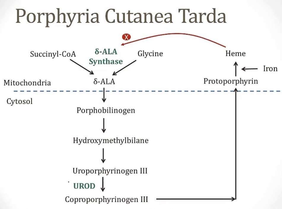 <p>-acquired</p><p>-UROD; uroporphyrinogen</p><p>-uroporphyrin; skin damage on exposure to light; tea-colored urine</p><p>-phlebotomy</p>
